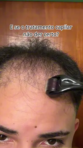 Estou em #tratamentocapilar desde o dia 01 de Outubro de 2024, e sinto que estou cada vez mais próximo do resultado final! Depois de passar pelo shedding, meu #cabelo está voltando cada vez mais forte! Basta ter paciência, disciplina e força de vontade pra lutar contra a #calvicie e deixar de ser #calvo