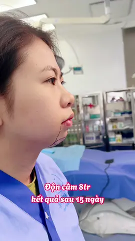 Độn cằm 8tr sau 15 ngày .. 