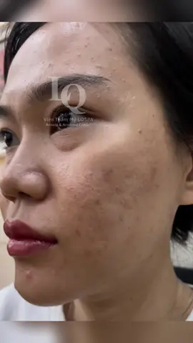 Đẹp lên #chamsocdamun#chamsocdaseo#chamsocdanam#tanbinh#govap #Lequynh #quynhle#lqspa #hocnghespa  #chamsocda #lequynhspa #vienthammylqspa#lqspabeautyacdemy #nanmunbangtay #nanmunbangtambong # nanmunbangcay