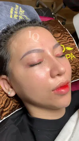 Cam thường #lấynhanmunbangtay#chamsocdamun#chamsocdaseo#chamsocdanam#tanbinh#govap #Lequynh#Lqspa#hocnghespa  #chamsocda #lequynhspa #lequynhspahcm#vienthammylqspa#lqspabeautyacdemy#LQSPABeaty&Acedemy  #laymunbangtămbông 