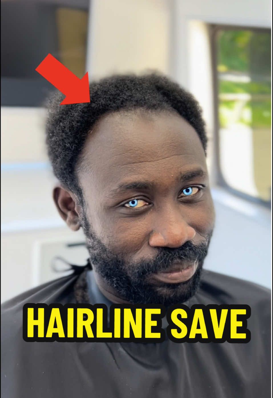 Did I Save Him ? #hairline #hairtransformation 