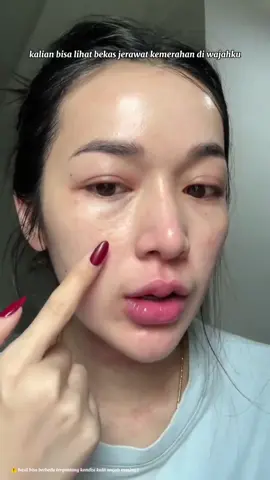 kalo lagi jerawat on off  dan banyak bekas jerawat tapi tetep mau make up mending pake sunscreen tint aja, lebih enteng dipakenya hasilnya natural dan ga dempul💕🥰 #kjoel #kjoelskincare #viral #korean #sunscreen #sunscreentint 