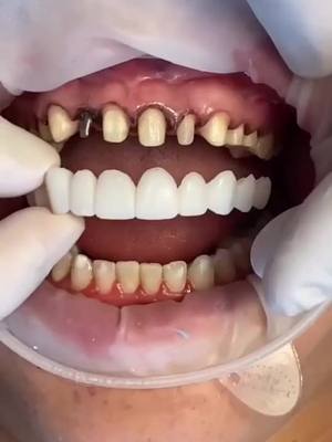 Upgrade your denture game! DlYSTAR™ ADA - certified moldable solutions here.