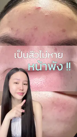 ปัญหาผิวหน้าพัง 🥹🥹🥹🥹 #drleo #drleoth #drleo7xceramide #moisturizer#ceramide #เซราไมด์ #มอยเจอร์ไรเซอร์ #ผิวแพ้ง่าย #บำรุงผิวหน้า#บํารุงผิวหน้า์ #ใช้ดีบอกต่อ #fyp 