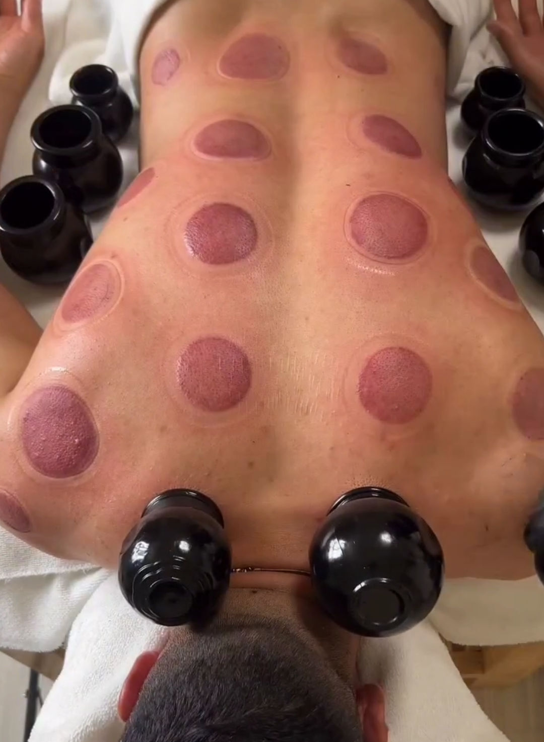 cupping massage 🔥 . #cuppingmassage #cuppingtreatment #massagebody  #ماساژیست #بادکش_گرم 