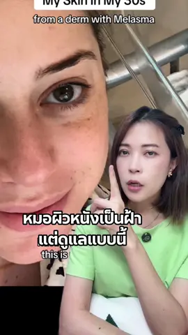 หมอผิวหนังเป็นฝ้าแต่ดูแลแบบนี้ #มะเหมี่ยวปันสวย #รู้จากtiktok #tiktokuni #ฝ้า #รักษาฝ้า #วิธีดูแลฝ้า #ครีมรักษาฝ้า 