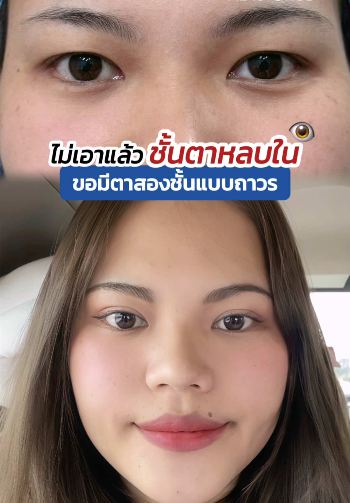 ไม่เอาแล้วชั้นตาหลบใน ขอมีตาสองชั้นแบบถาวร #skyclinic #รีวิวตาสองชั้น #สกายคลินิก #sweeteyes #หมอตา #ทีมแพทย์หมอสกาย #ทำตาที่ไหนดี 