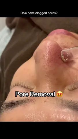 Pore vacuums help deeply cleanse the skin by removing blackheads, excess oil, and debris that regular washing may miss, improving skin texture and preventing breakouts. They enhance blood circulation, promoting a healthy glow, and allowskincare products tal absorb more effectively. As a noninvasive method, they are gentler than manual extraction, but it's important to use them carefully—limiting sessions to once a week, steaming beforehand to open pores, and avoiding high suction to prevent irritation or bruising. #blackhead #skincare #satisfying (via unberry.beauty/tt)