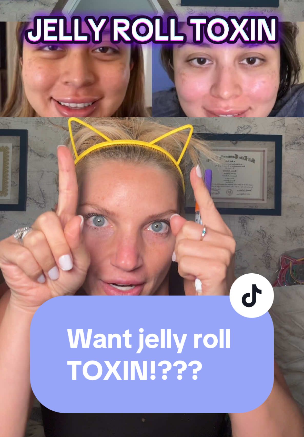 Face injections tox #neurotoxin #xeomin #botox #aesthetics #facialexpressions #injector #fypシ #fyp #howtotiktok #medicaltips #medicaltiktok #badbotox #botoxresults #dysportinjections #injector #nursepractitioner @Xeomin Aesthetic 