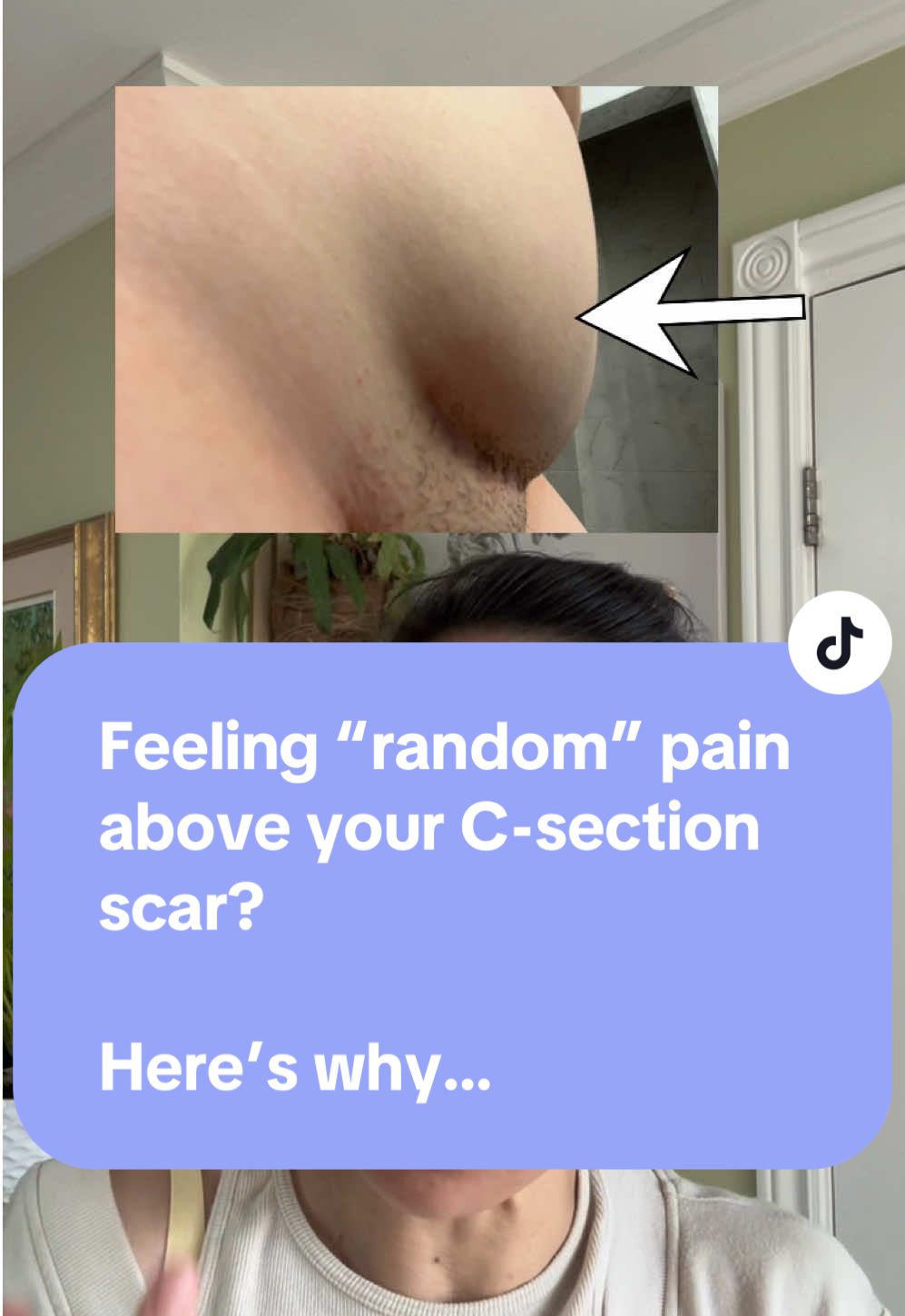 ❗ Most C-section moms have THIS hidden pain - and doctors won't tell you why You know that mysterious pain between your scar and belly button?  The one that hurts for waaaay longer than the actual scar itself? Well, that’s COMMON - and here’s why: 🤯 There are ACTUALLY 4 CUTS that happen during your C-section: 1. The External Incision - This is the ONLY ONE YOU CAN SEE - the horizontal line just above your pubic bone. It goes through skin and fat. Most doctors only mention this one when discussing recovery. 2. The Myofascial Incision - Here's the hidden truth: There's a SECOND horizontal cut made through your muscle covering (the fascia). It's located 2-3 inches ABOVE your visible scar. This one causes most of your lingering pain! P.S. - If you're feeling pain or tightness above your C-section scar months later, you're not imagining it. It's this hidden incision causing problems. Comment below if this describes YOUR experience - I want to know how many women are dealing with this! 3. The Vertical Cut - Your abdominal muscles are separated vertically down the middle (through the linea alba). That’s right - right through your DIASTASIS. 4. The Uterine Cut - The deepest incision goes through your uterus itself. Yes, scar tissue holds it together. No, you can’t really massage this deep.  Let me be clear: That pain and tightness across your middle? The lingering pulling when you stand or do Cobra? The pain that 