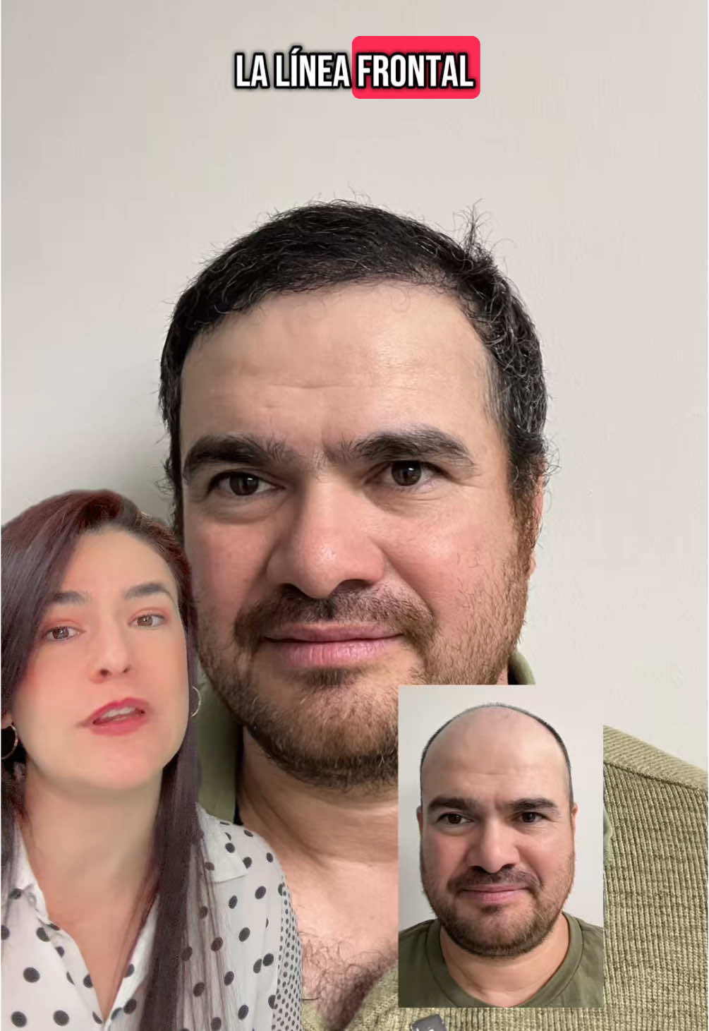 Antes y despues de un #trasplantecapilar Agenda tu cita de #evaluacion hoy.              Before and after a #hairtransplant Get your #free evaluation today. #hairgoals #hairsurgery #cirugiacapilar #beforeandafter #antesydespues 