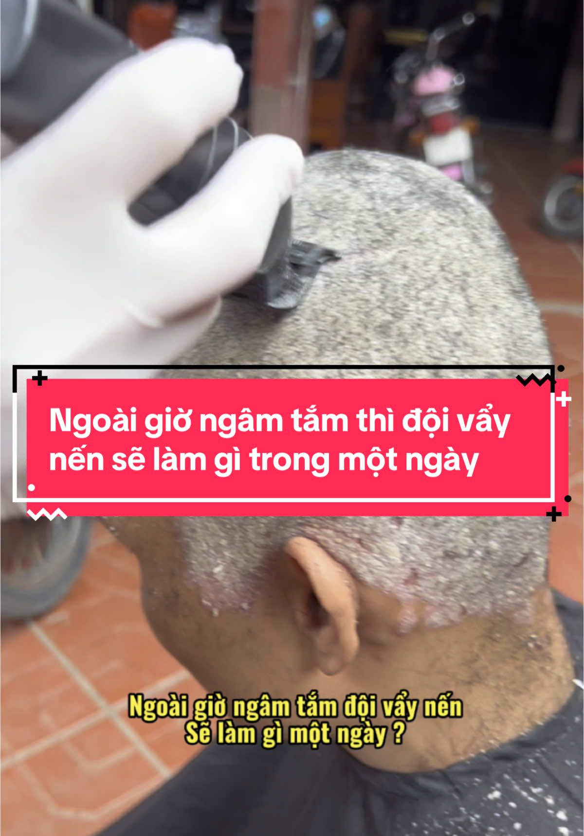 Ngoài giờ ngâm tắm thì đội vẩy nến sẽ làm gì trong ngày? @Thị Tuyến DC 35(2) #vẩynến #viêmdacơđịa #viêmdatiếtbã 