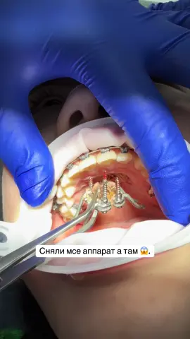 Консультация бесплатно. #рек#реки#рекомендации #аиндентпремиум #брекеты #здоровье #зубы #аиндент #тараз_казакстан #тараз_казакстан🇰🇿🇰🇿🇰🇿🇰🇿♥️♥️♥️ #зуб #рекомендациитикток #тараз_казакстан 