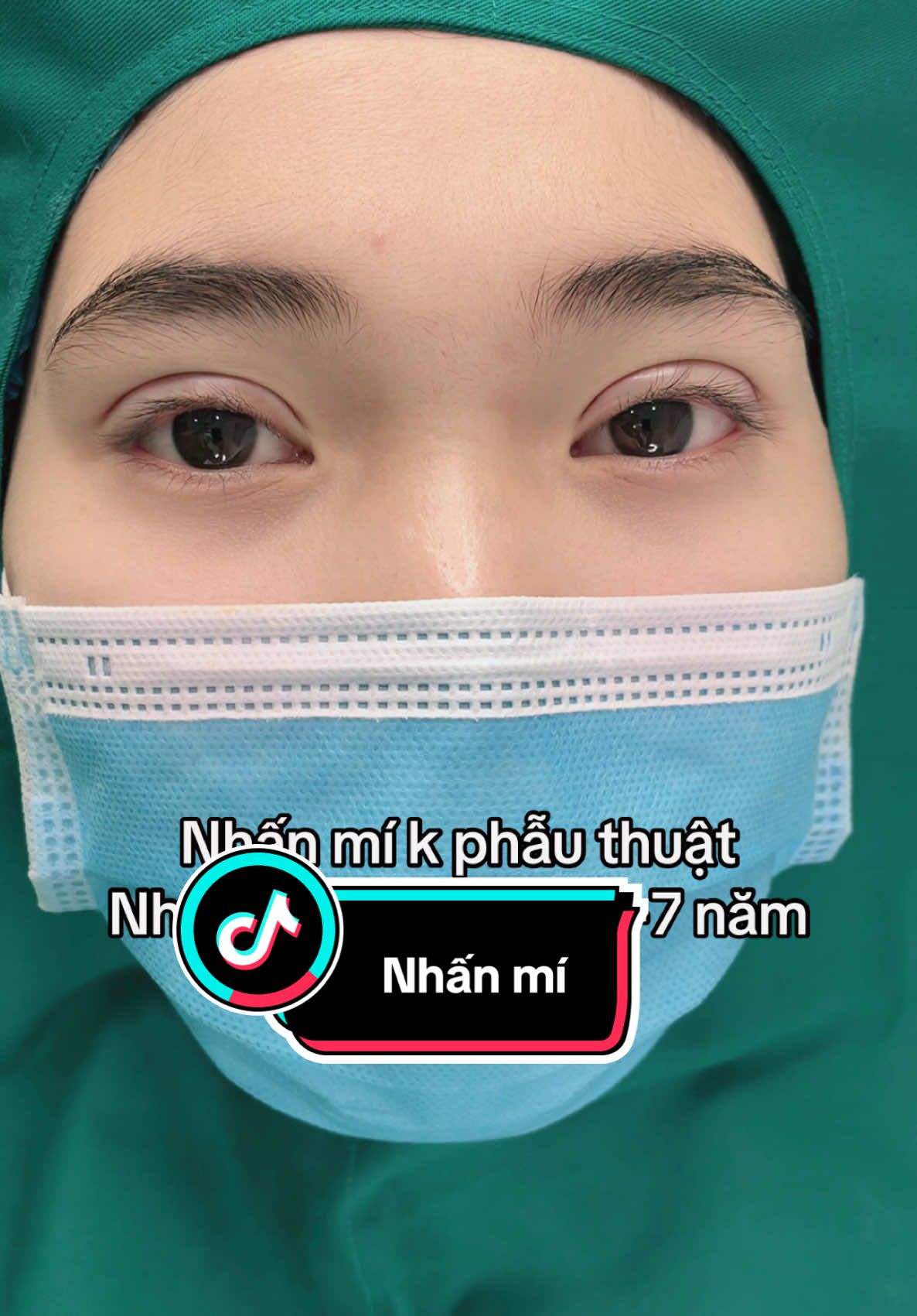 Nhấn mí giữu dc 5-7 năm #cắtmíđẹp #nhấnmí #treocungchanmay #trend #mí #tik_tok #xuhuong #thẩmmỹ #tiểuphẫu #cắtmí #viral #làmđẹp 