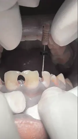 Tooth nerve 🦷 #dentist #dental #dentistry 