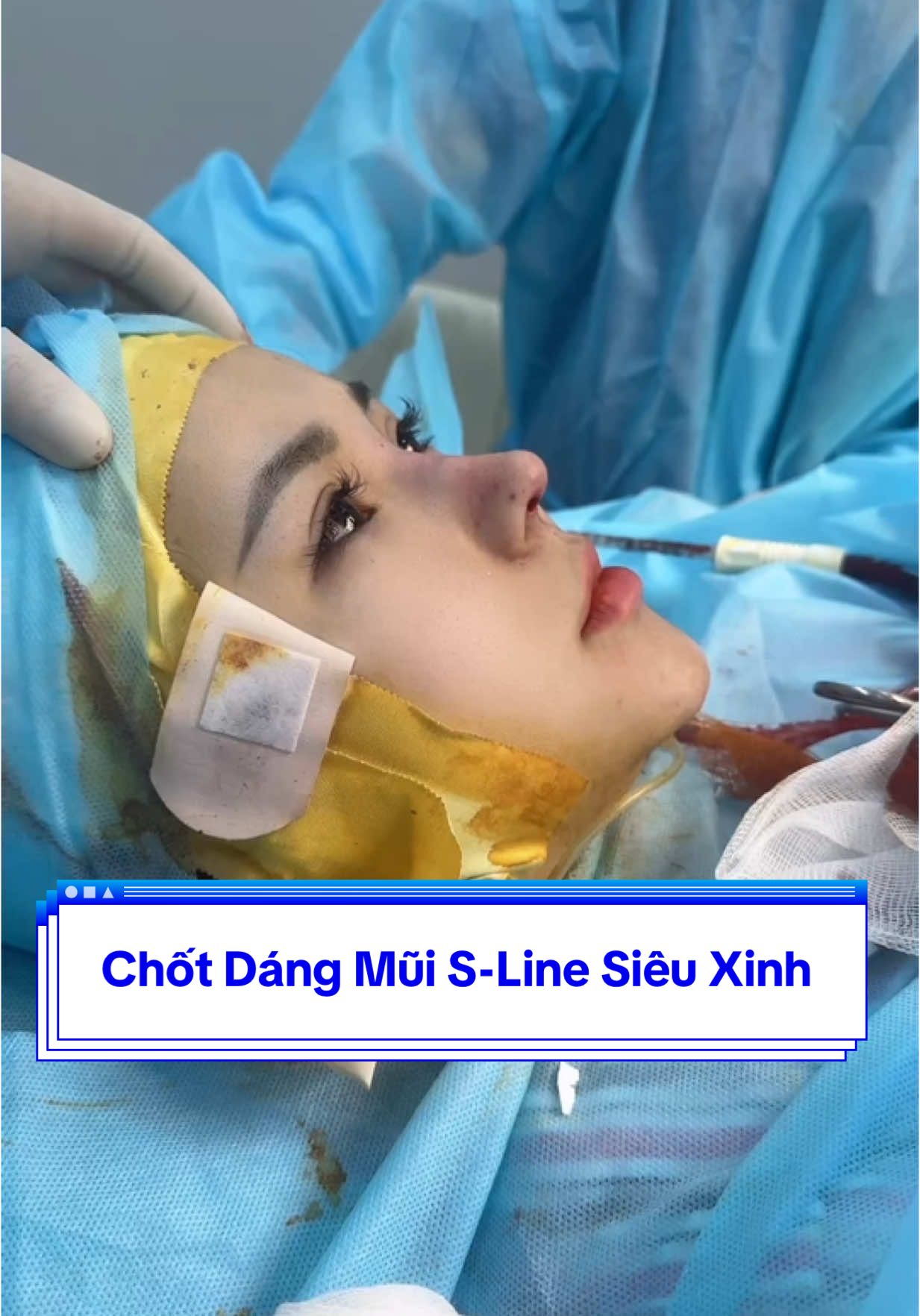 Dáng Mũi Cấu Trúc S-Line Siêu Xinh cho Ce#DrTRANG #DrTrangnana #muitrunghoa #nangsuamui #nangsuamuiFom #lamdep #trend 