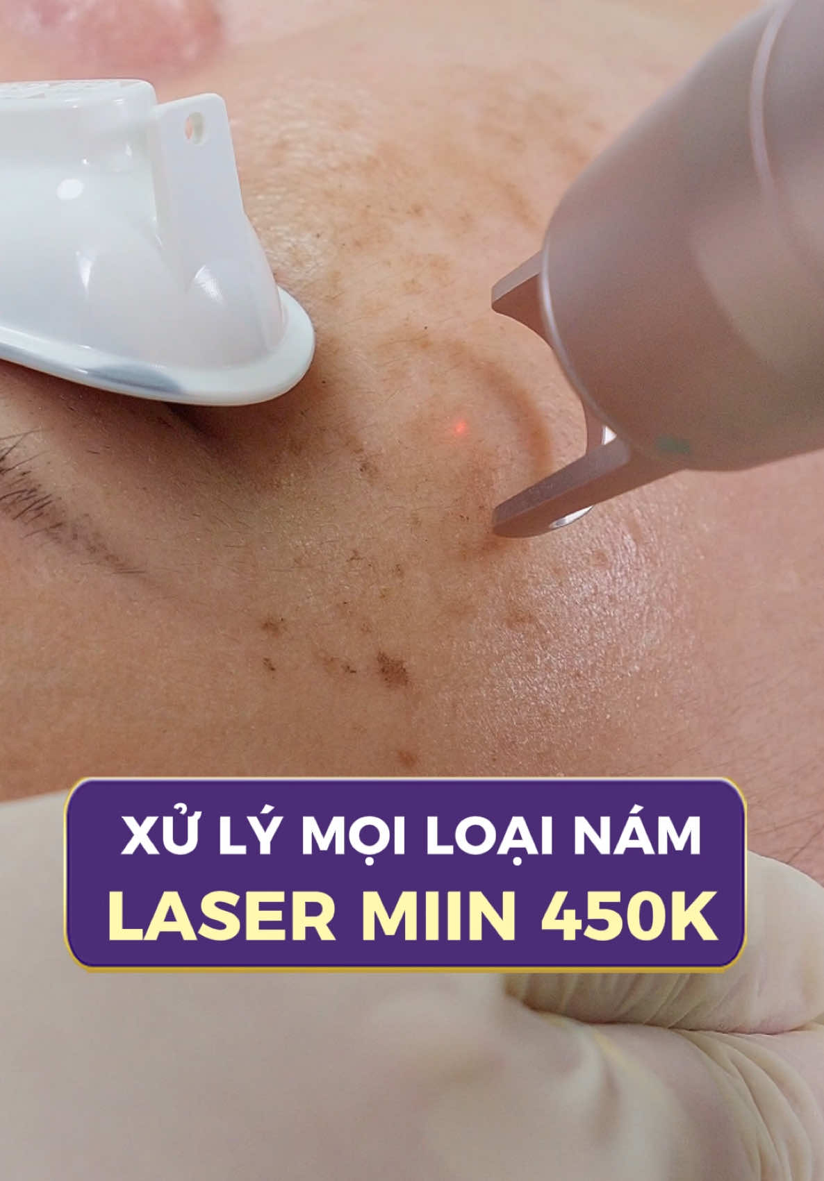 CHỈ 450K - CẢI THIỆN NÁM, TÀN NHANG sau 1 buổi. Ưu đãi áp dụng trong tháng, đăng ký giữ ngay SUẤT 450K tại đây! #thammylinhanh #tmvlinhanh #lamdep #trehoada #laser #dadep #dacangbong 