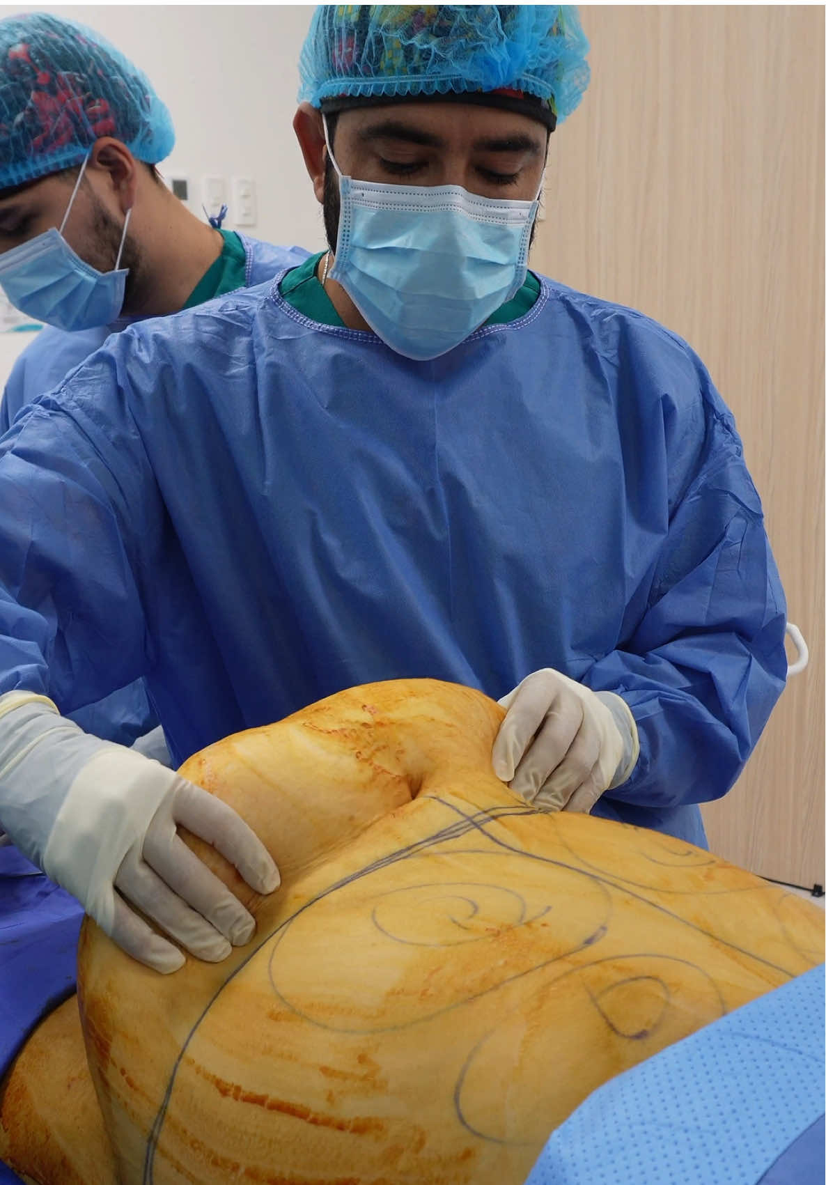 😎 En algunos casos, el exceso de piel y grasa en el abdomen no es solo estético, sino que afecta la movilidad, la higiene y la calidad de vida. ☺️ En este procedimiento retiramos un colgajo abdominal de 4.6 kg, con mínima liposucción para evitar complicaciones. Una cirugía que mejora el bienestar desde lo funcional. @david.chanchi 📲 Solicita tu valoración al WhatsApp (+57)319-6466205 o MD.  📍Calle 1 #12-17 Luxor, oficina 304 Armenia 📍También en Pereira   #abdominoplastia  #cirujanoscolombianos  #cirujanoplastico  #armeniacolombia  #cirujano  #quindiocolombia  #liposuccion 