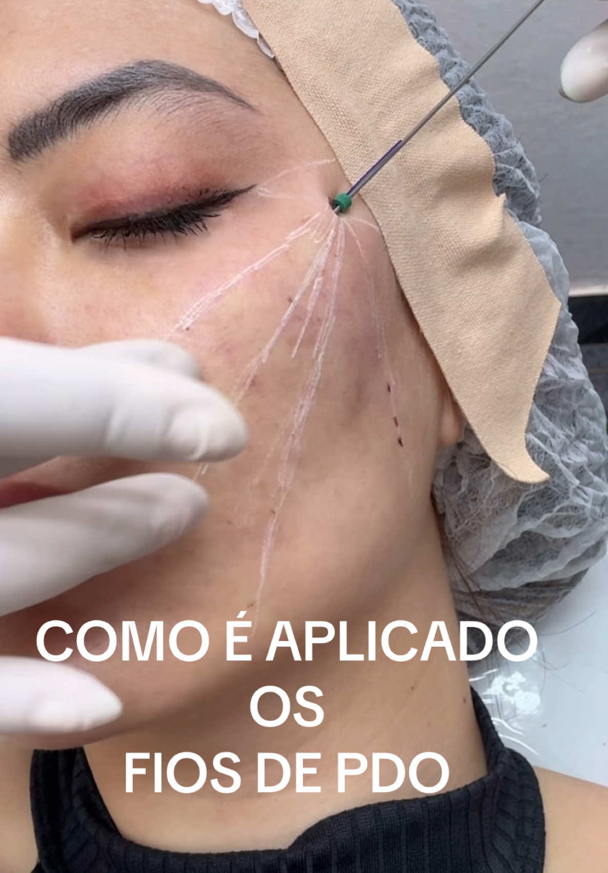 COMO É FEITA A APLICAÇÃO DE FIOS DE PDO 
