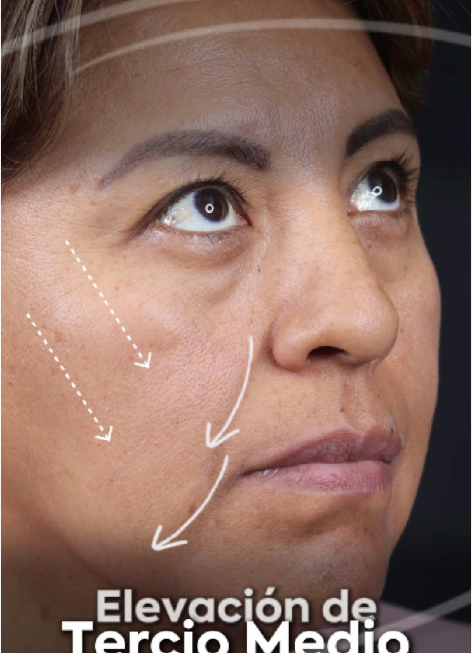 ✨ Rejuvenecer sin perder tu esencia. Nuestra paciente luce un rostro más firme y armonioso gracias a la elevación del tercio medio. Este procedimiento devuelve soporte a las mejillas, mejora los surcos y aporta frescura al rostro completo. En Elebelle, cada detalle cuenta. 💫👁️‍🗨️ #blefaroplastia #elevacionterciomedio #tacna #peru #elebelle #bellezanatural #liftingfacial #laser #chile 