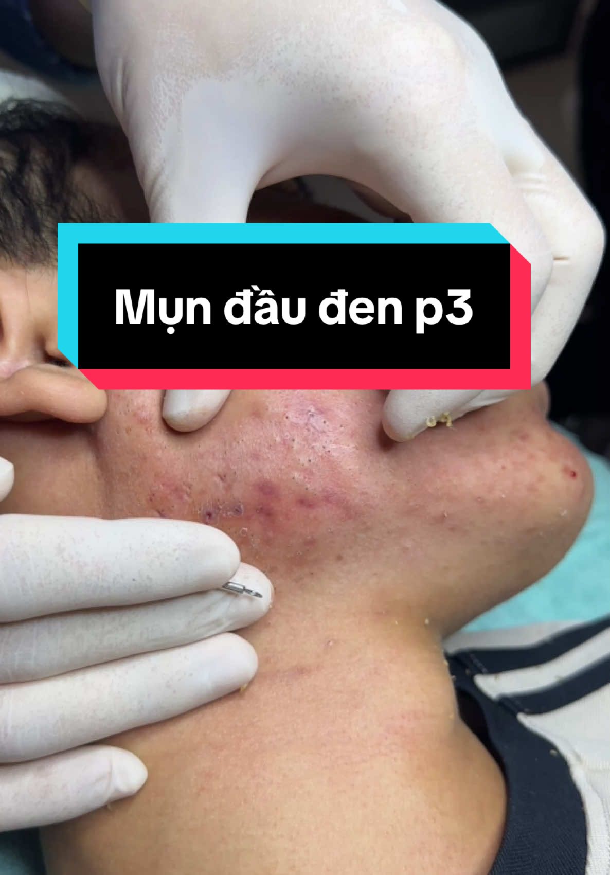 Mụn đầu đen p3#winspavungtau #trimunvungtau #nanmunvungtau #nanmun #spauytinvungtau 