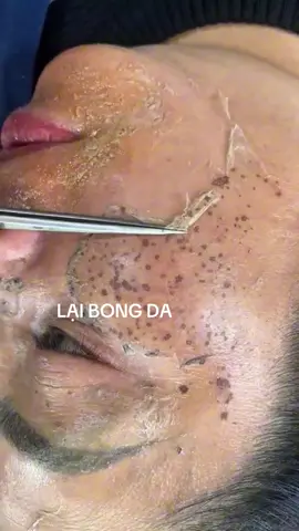 Bong nám tàn nhang#tàn_nhang #làmđẹp #táitạoda #xuhuongtiktok 