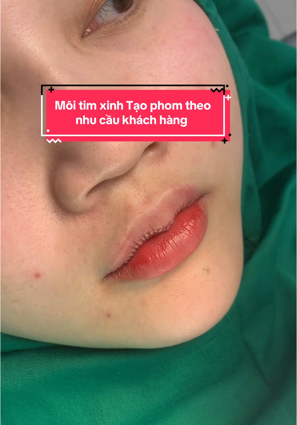 Cắt môi tim Người có môi trên dày, thiếu độ cong, hoặc không rõ đỉnh tim.#cắtmôitimtựnhiên #thẩmmycamellia #cătmoitim #nhấnmiplasma #cắtmoitraitim #cắtmoitraitim 