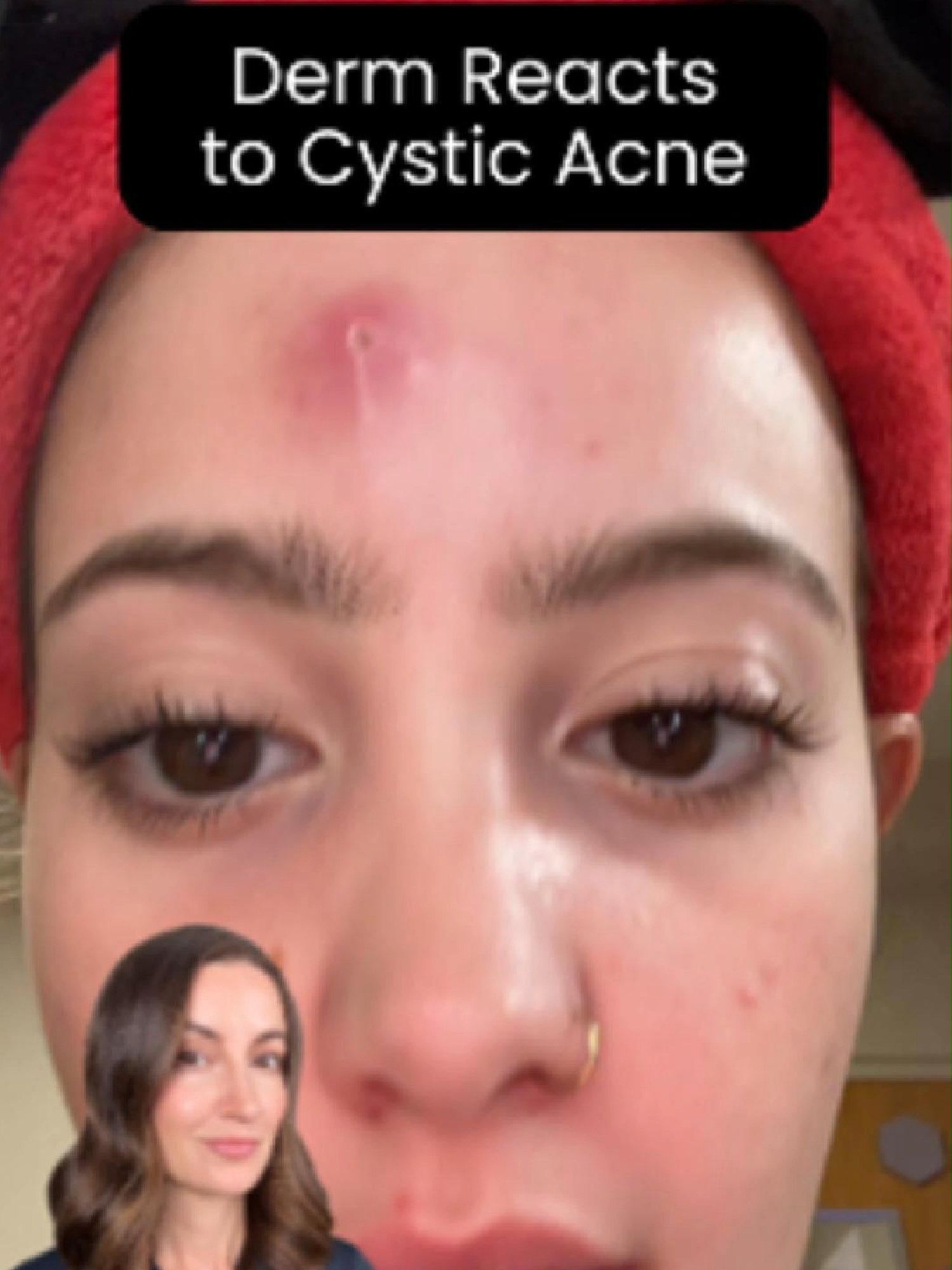 Deep, painful cystic acne isn’t something to handle alone. Yes—using a combo Rx (adapalene + BPO) and hydrocolloid patches is smart… …but this is not the time for spot treatments or popping. 👉 Why? You risk: Delayed healing Scarring and dark spots Even MRSA (a resistant staph infection that lives on our skin!) Your derm can help with steroid injections, cultures, and stronger treatments if needed.  Don’t wait until it gets worse. 👩‍⚕️ #cysticacne #mrsa #DermApproved #AcneSolutions #draleksandrabrown #SkinTips #SKINCARE