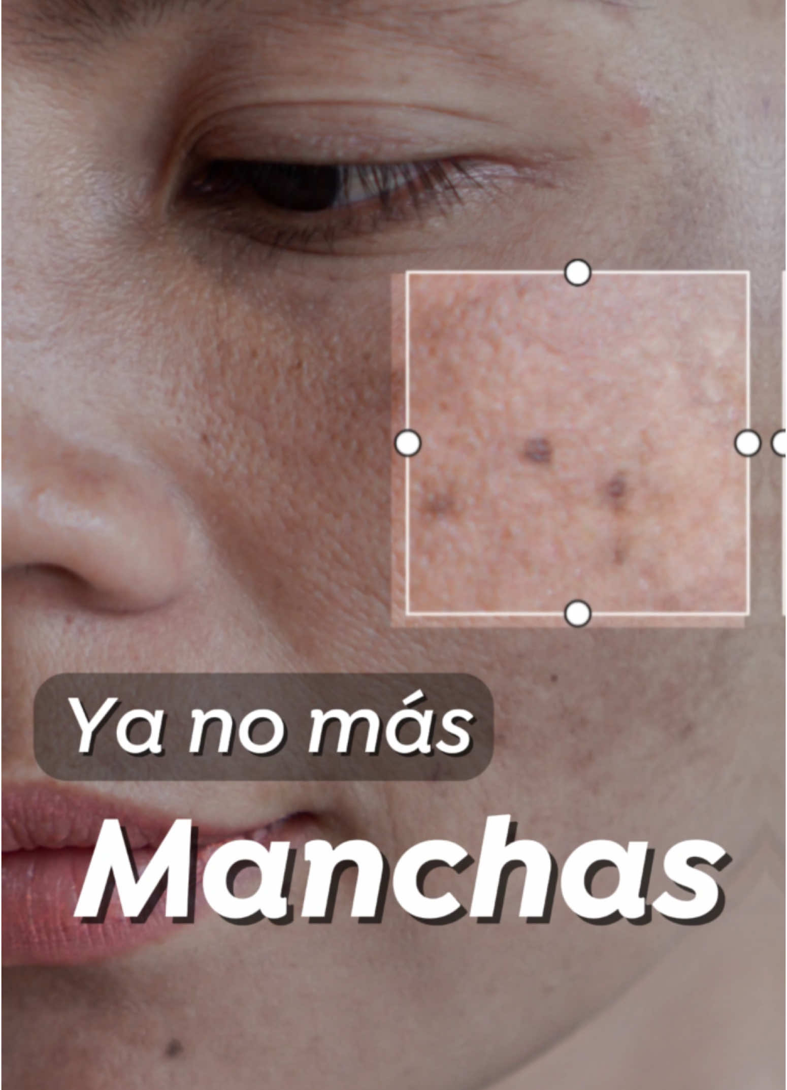 ✨ ¿Manchitas en el rostro que no se van con nada? El láser Starwalker es tu aliado para tratar esas manchas solares o melasma que afectan la uniformidad de tu piel. En Alma Centro Estético Láser trabajamos con precisión y tecnología para que tu rostro luzca más luminoso y uniforme. 💬 ¿Quieres saber si este tratamiento es para ti? Escríbenos y recibe una evaluación personalizada. #dermapenfacial #bellezanatural #tratamientosfaciales #Tacna #peru #almacentroesteticolaser #centroestetico #tacna #cuidadodelapiel #depilacionlaser #agendatucita 