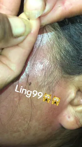 Remove lice#omg #lice #liceremoval 