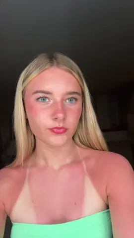 wear sunscreen!!! #fypシ #sunburn #foryou #sunscreen 