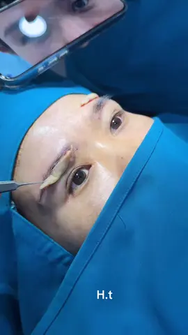 Treo cung giấu chỉ trả c khách Bh ĐNai #trending #thịnhhành #virall #plastic_surgery #dr #phòng_khám_thẩm_mỹ #chuyên_tiểu_phẫu #nâng_cung_mày  #khâugiấuchỉ #treo_cung_chân_mày 