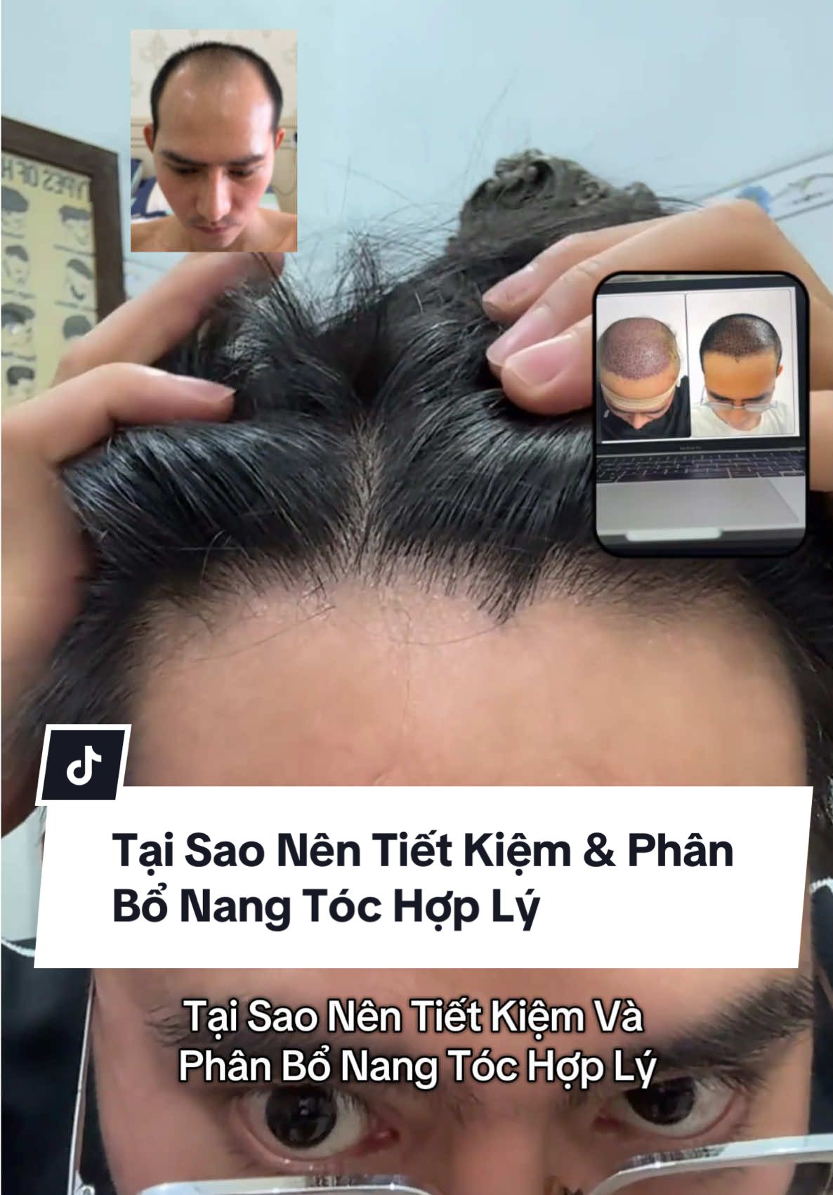 Tại sao khi cấy tóc nên tiết kiệm và phân bổ nang tóc hợp lý? #caubethoathoi #caytoctuthan #caytocdhi #cấytóc #hairtransplant #chamsoctoc #hoidau #hoidaurungtoc #reviewcaytoc #cậu_bé_thoát_hói #kinhnghiemcaytoc #chuahoidau #xuhuong 