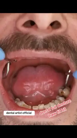 #partial #teeths #full #denture #foryoupage❤️❤️ 