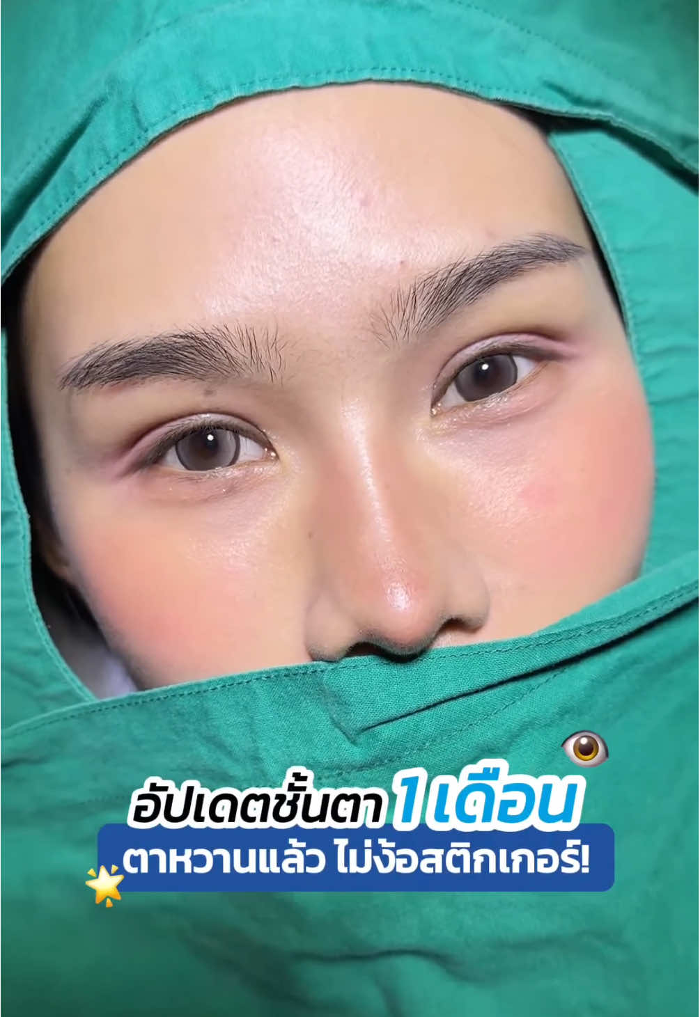 อัปเดตชั้นตา 1 เดือน #รีวิวตาสองชั้น #หมอสกาย 🌟 บอกลาสติกเกอร์ #จักษุแพทย์ #skyclinic #สกายคลินิก #ทำตาที่ไหนดี #ศัลยกรรมตา 