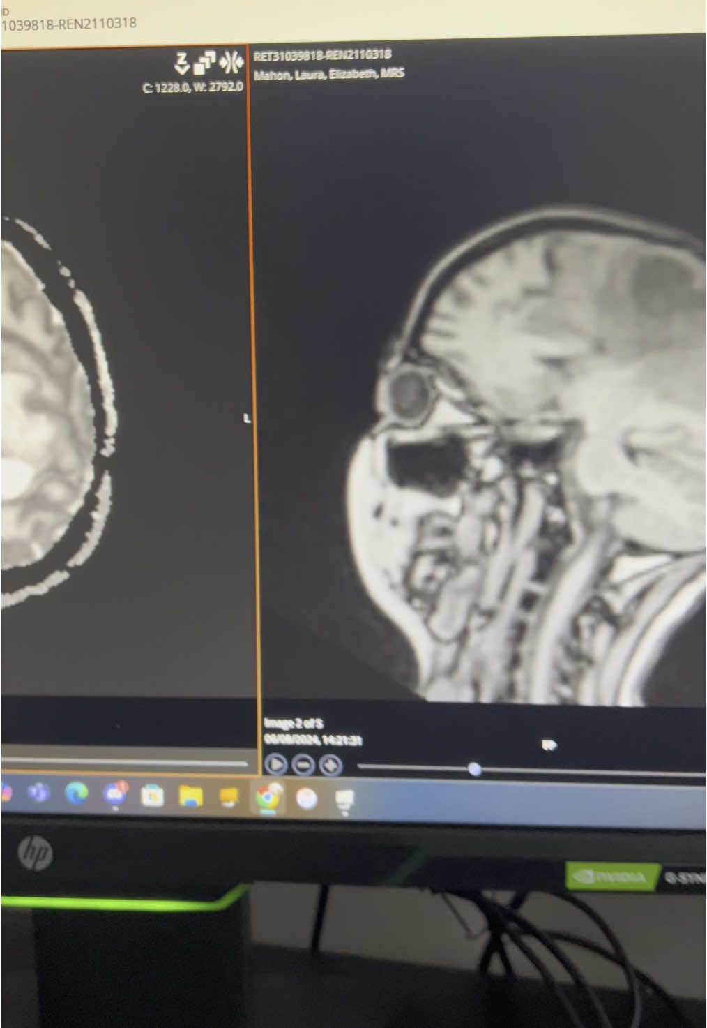 It’s been a long battle with cancer. Every day I lose another piece of myself. It’s not easy, but I post these videos to raise awareness of this disease. This is mine any many others reality. I hope that by sharing my struggles with you all, I’m making a difference. #cancersucks #terminal #braintumour #stage4 