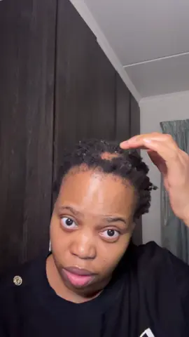 I was diagnosed with CCC Alopecia in 2019. It’s been such a struggle trying to accept that my hair will never grow back. I’ve done minoxidil. I have tried the natural remedies. Perhaps I just need to shave it off and be done. #selflovejourney #alopecia 