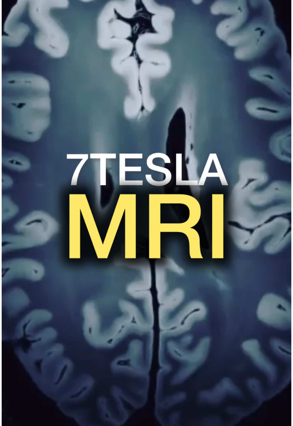 MRI 7 Tesla adalah jenis pemindai MRI yang menggunakan medan magnet yang sangat kuat (7 Tesla) untuk menghasilkan gambar yang lebih detail dan akurat daripada MRI standar. Alat ini memungkinkan untuk mendeteksi kelainan yang lebih kecil dan lebih halus, terutama pada otak dan jaringan lunak, seperti lutut dll. Meskipun menawarkan banyak manfaat, MRI 7 Tesla juga memiliki beberapa keterbatasan, seperti adanya potensi artefak pada struktur tertentu di dekat dasar tengkorak dan adanya kendala keamanan yang lebih ketat untuk objek logam yang ditanamkan di dalam tubuh.  MRI 7 tesla dan diatasnya biasanya digunakan untuk riset dan bukan untuk pemeriksaan pasien rutin. Saat ini, MRI 7 Tesla banyak digunakan di lembaga penelitian dan universitas di seluruh dunia. Beberapa contohnya meliputi Carle Illinois Advanced Imaging Center di Urbana, German Ultrahigh Field Imaging (GUFI) di Jerman, dan sejumlah institusi di Amerika Serikat seperti Mayo Clinic dan UC Berkeley dsb. #mri7tesla #tesla #mri #radiology #research #university