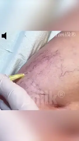 🦵 Müde von geschwollenen, schmerzenden Beinen? Das Cvreoz® LegRenew Patch hilft dir! 🙌 Sichtbar in nur 7 Tagen mit Mikronadel-Technologie und natürlichen Kräutern. ✅ Reduziert sichtbare Venen & Schwellungen 🌿 ✅ Fördert die Blutzirkulation 💉 ✅ Keine Operation, nur schnelle Erleichterung zu Hause! 🏡 Einfach anwenden und entspannen - es funktioniert, während du schläfst! 😴 #Krampfadern#Schmerzlinderung#Selbstbewusstsein#Naturheilmittel