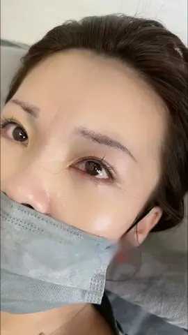 了解提眉去眼袋加line：plum886 #提眉 #無痕提眉 #去眼袋 #法令紋 