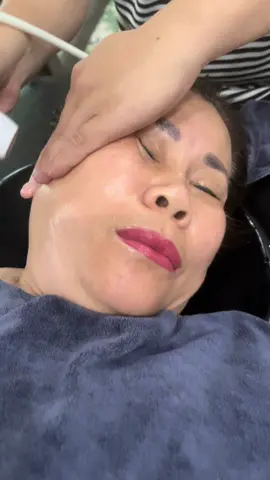 Nâng cơ xoá nhăn bằng máy đa tầng