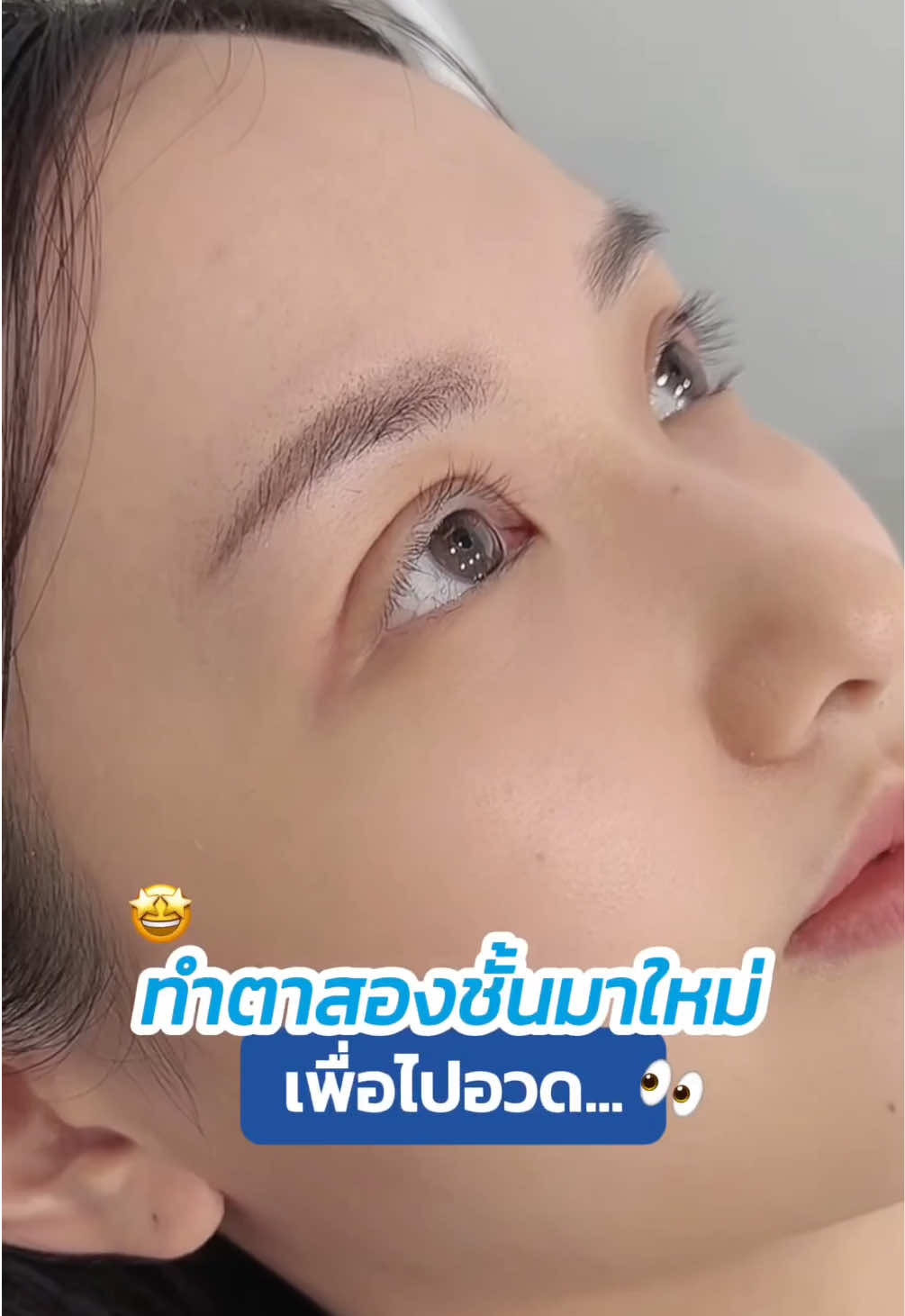 #ทำตาสองชั้น มาใหม่ 🤩 เพื่อไปอวด… #รีวิวตาสองชั้น #ทีมแพทย์หมอสกาย #skyclinic #จักษุแพทย์ #ทำตาที่ไหนดี #หนังตาตก #สกายคลินิก #ศัลยกรรมตา 
