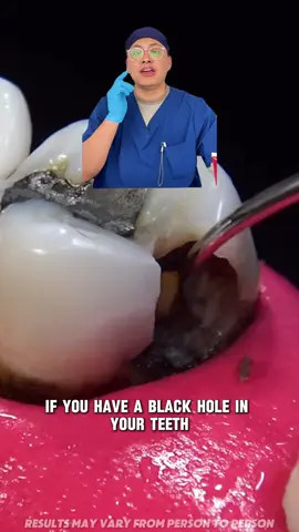 If u have black holes in your #teeth ? Pay attention #outdoorfun #toothpaste #teethcare #Toothdecay #toothpaste  #Dentalcaries #Fixedteeth #Dentalcare #teeth #tooth #Gingivitis #Oralbacteria #DentalHealth #healthy 