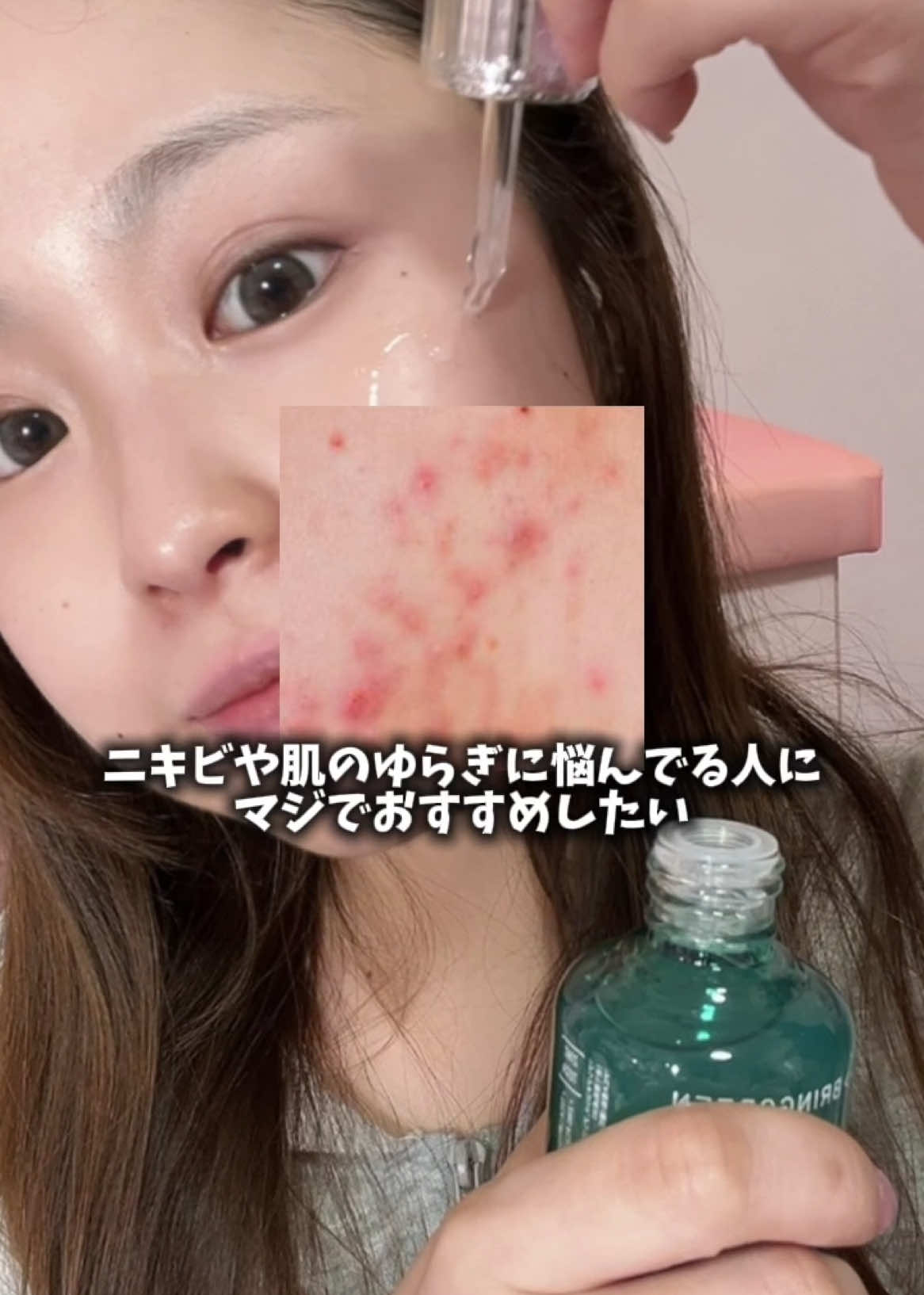 ニキビや肌のゆらぎに悩んでる人にマジでおすすめしたいアイテム✨️ これ、韓国オリーブヤングでもNo.1トラブルセラム*を獲得したくらい評価されてる大人気アイテム🙌 *2024年オリーブヤングの商品名に「トラブル」というキーワードを含むエッセンスカテゴリー内の商品の売り上げ基準（オリーブヤング調べ） 5/27～Q0010で発売開始！ 次のQ0010セールでは「ジングテカBセラムセット」が定価¥2,700円→ ¥1,960円（27.4%off）でget出来ちゃう❣️ *5/31〜の価格です しかもお値段そのままで、 「ティーツリーCトナー100ml」もギフトでついてくるの！ 気になる方は是非チェックしてみてね︎💕︎ #PR#ブリングリーン #BRINGGREEN#ジングテカセラム #ジングテカ #肌トラブル#ニキビケア