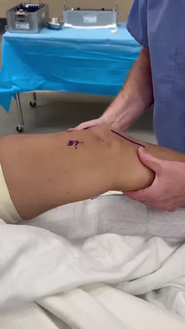 Getting a better look before we get to work 👀🦵 This is an exam under anesthesia (EUA) on a patient with a torn ACL and a posterolateral corner injury — including a fibular avulsion of the LCL, biceps femoris, and lateral capsule. These injuries can be complex and unstable, which is why a thorough EUA helps us confirm the extent of damage before heading into surgery. The knee tells us a lot when the muscles aren’t guarding — and every bit of that info helps us build the right plan to get you back to full strength. Let’s keep you moving — book your appointment today www.ryvesmooremd.com #RyvesMooreMD #WhySOG #Orthopedics #ACLInjury #KneeExam #SportsMedicine #EUA #PosterolateralCorner #TeamMoore #KneeStability #StayMoving #ChooseSOG