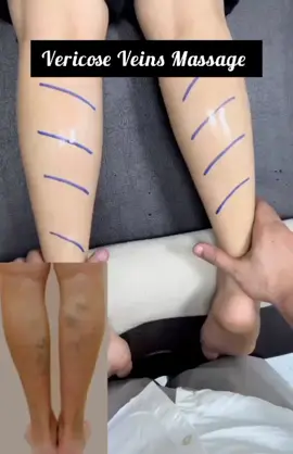 Varicose veins massage   #yogawiththb #varicoseveintreatment #PainRelief #veins #varicose 