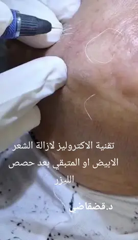 #epilation #epilationdefinitive #laserhairremoval #laser 