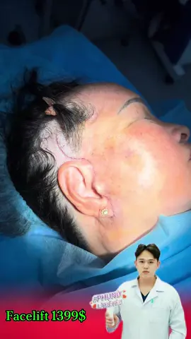 Facelift #DrTotAesthetic #fyp #xuhuongtiktok #facelift 