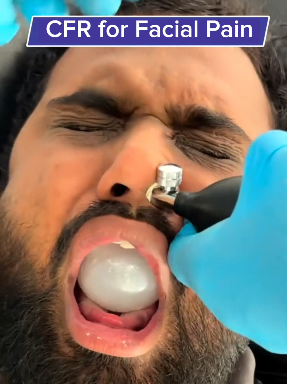 CFR for Facial Pain