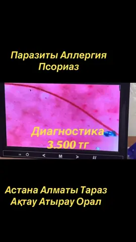 #аллергия #антипаразитарнаяпрограмма #анемия #паразитыучеловека #псориазлечится 